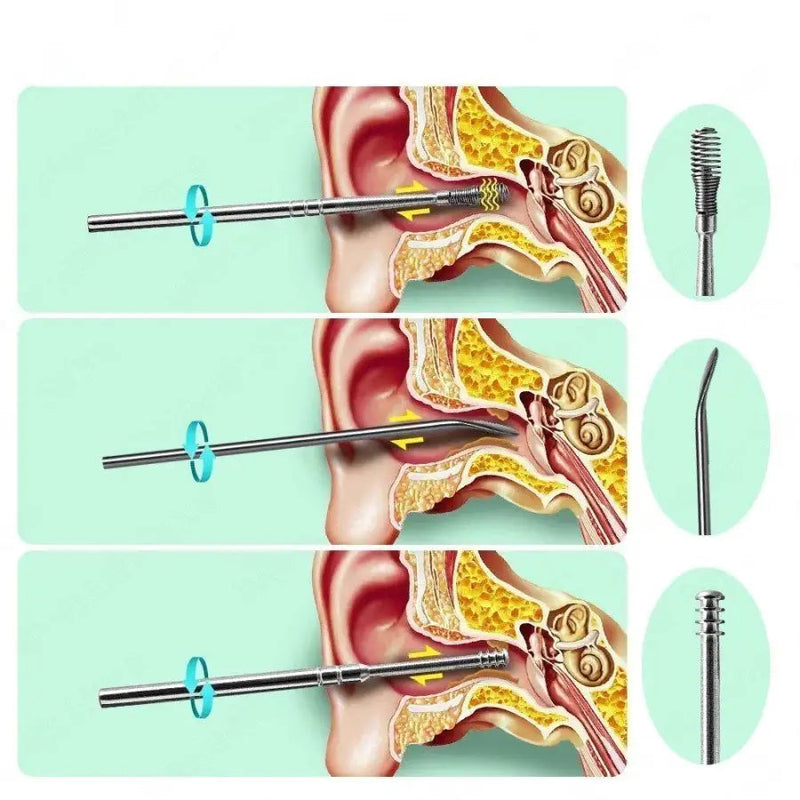 Removedor Cera De Ouvido Kit 6 Peças Aço Inox Limpeza - Ear Cleaner™ SD22 Vendido e entregue por 